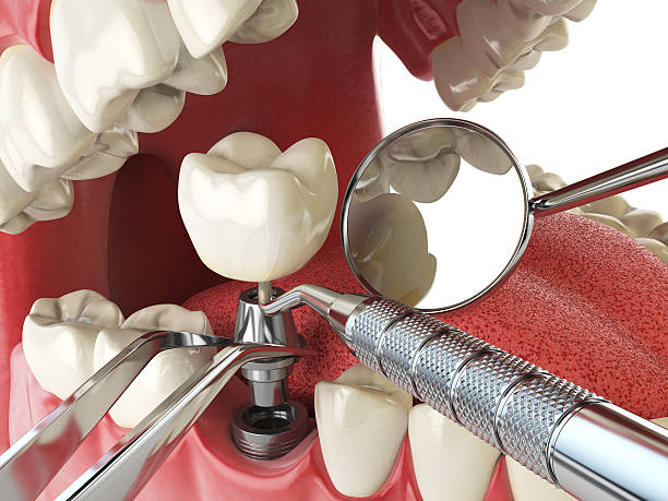 Best Chipped Tooth Repair Near Me  in Calverton, NY